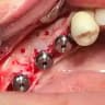 Dr Boostani (Basic implant)